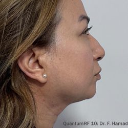 QuantumRF Before & After Patient #343
