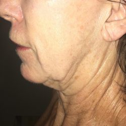 Morpheus8 Before & After Patient #350