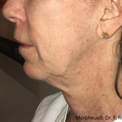 Morpheus8 Before & After Patient #350