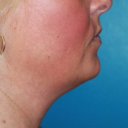 Facetite Before & After Patient #335