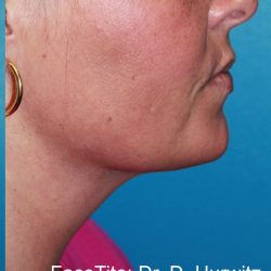 Facetite Before & After Patient #335