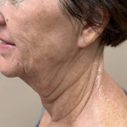 Morpheus8 Before & After Patient #351