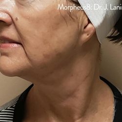 Morpheus8 Before & After Patient #351