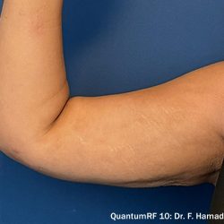 QuantumRF Before & After Patient #344