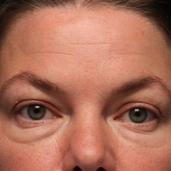 Facetite Before & After Patient #336