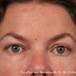 Facetite Before & After Patient #336