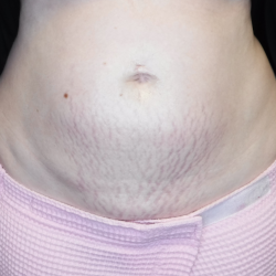 Morpheus8 Before & After Patient #352