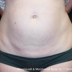 Morpheus8 Before & After Patient #352