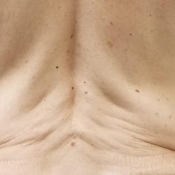 Morpheus8 Before & After Patient #353