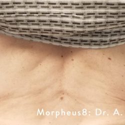 Morpheus8 Before & After Patient #353
