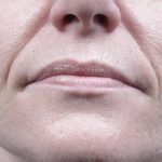 Forma Before & After Patient #434