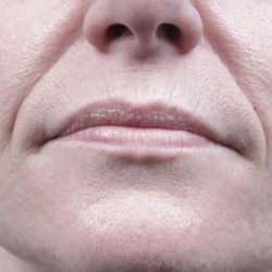 Forma Before & After Patient #434