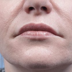 Forma Before & After Patient #434