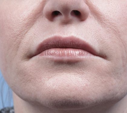 Forma Before & After Patient #434