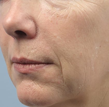 Forma Before & After Patient #433
