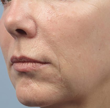 Forma Before & After Patient #433