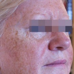 IPL Before & After Patient #437