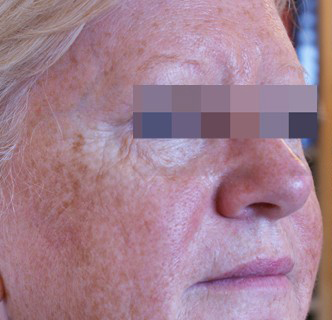IPL Before & After Patient #437