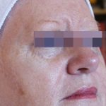 IPL Before & After Patient #437