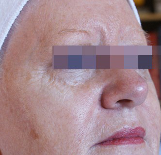 IPL Before & After Patient #437