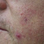 IPL Before & After Patient #438
