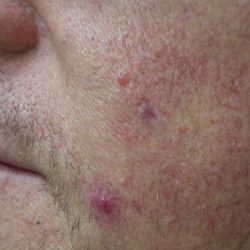 IPL Before & After Patient #438