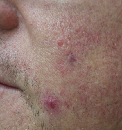 IPL Before & After Patient #438