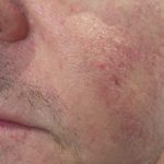 IPL Before & After Patient #438
