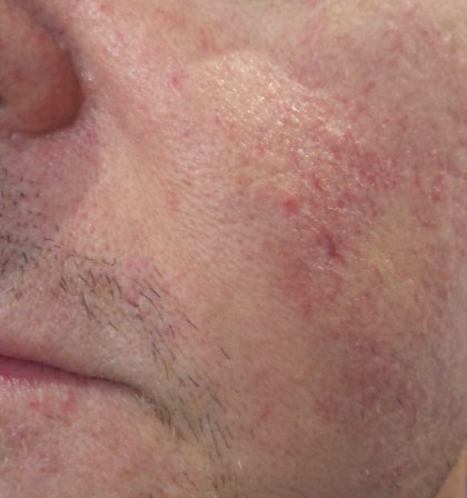 IPL Before & After Patient #438