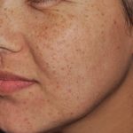 IPL Before & After Patient #439