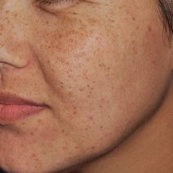 IPL Before & After Patient #439