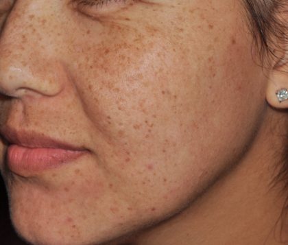 IPL Before & After Patient #439