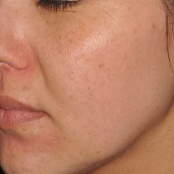 IPL Before & After Patient #439