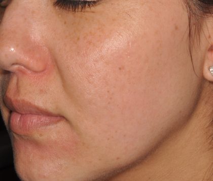 IPL Before & After Patient #439