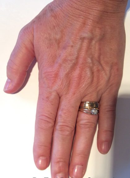 IPL Before & After Patient #440