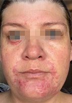 IPL Before & After Patient #441