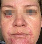IPL Before & After Patient #441