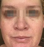 IPL Before & After Patient #441