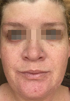 IPL Before & After Patient #441
