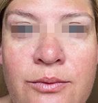 IPL Before & After Patient #441