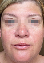 IPL Before & After Patient #441