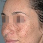 IPL Before & After Patient #436