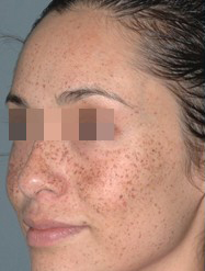 IPL Before & After Patient #436