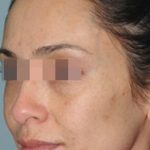 IPL Before & After Patient #436