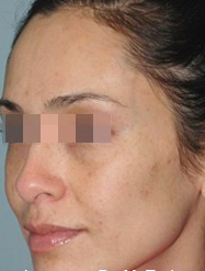 IPL Before & After Patient #436