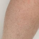 Laser Hair Removal Before & After Patient #435
