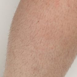 Laser Hair Removal Before & After Patient #435
