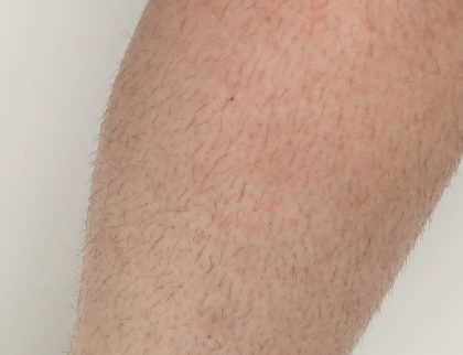 Laser Hair Removal Before & After Patient #435