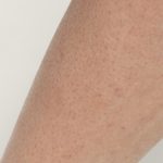 Laser Hair Removal Before & After Patient #435