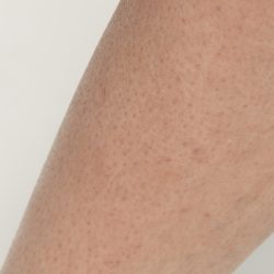 Laser Hair Removal Before & After Patient #435